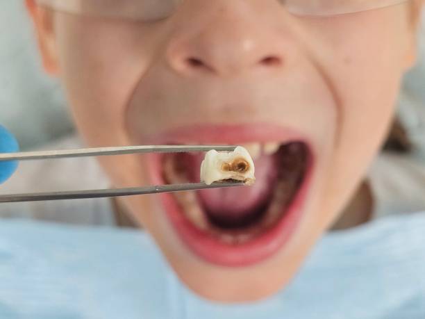 Best Cracked Tooth Emergency Dentist  in Richland, PA